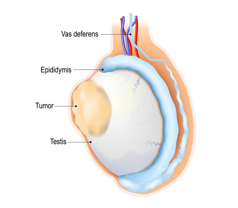 Cáncer de testículo
