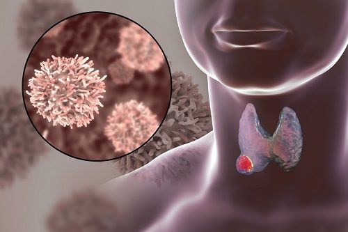 Síntomas del tumor en la tiroides