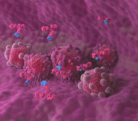 Cáncer de páncreas: ¿por qué tiene mal pronóstico?