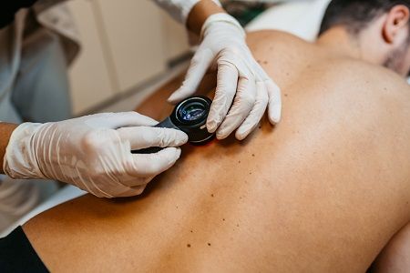 Especialista revisa los lunares en la espalda de un paciente