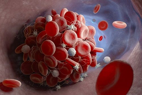 La formación de un coágulo de sangre en el interior de la vena