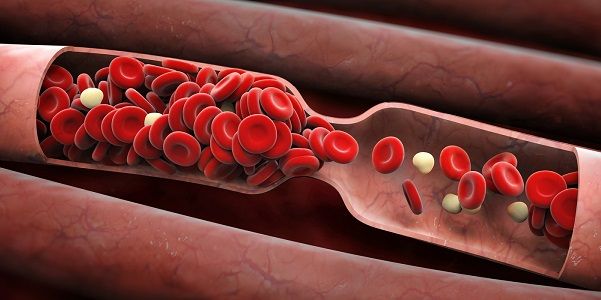 Un coágulo de sangre o trombo