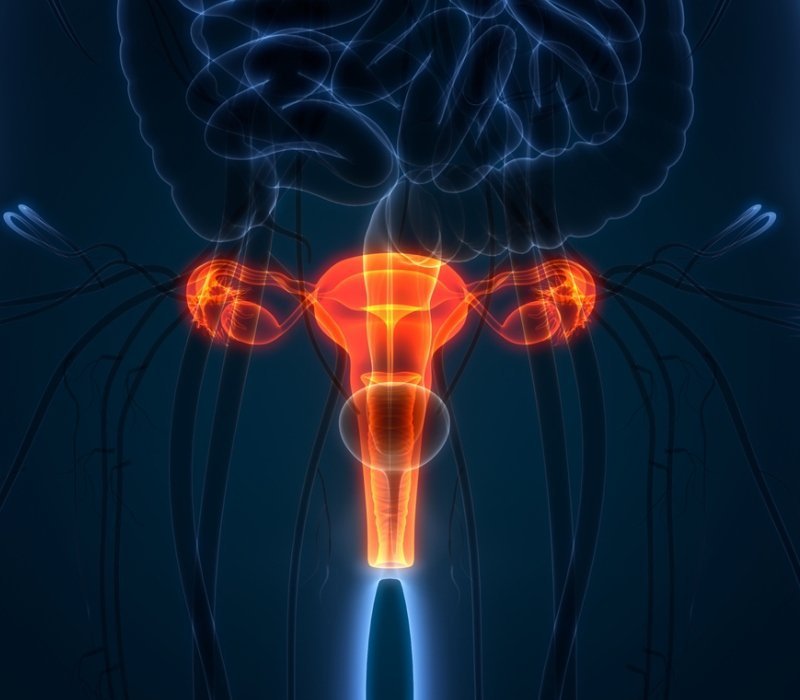 Endometriosis
