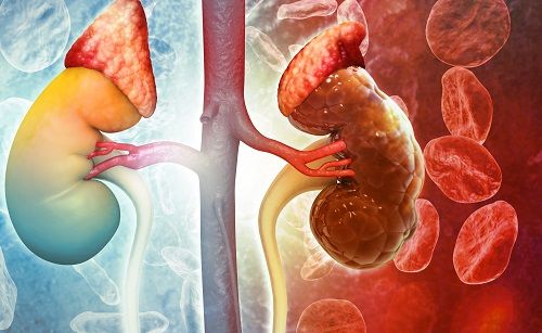 Ilustración de la enfermedad renal