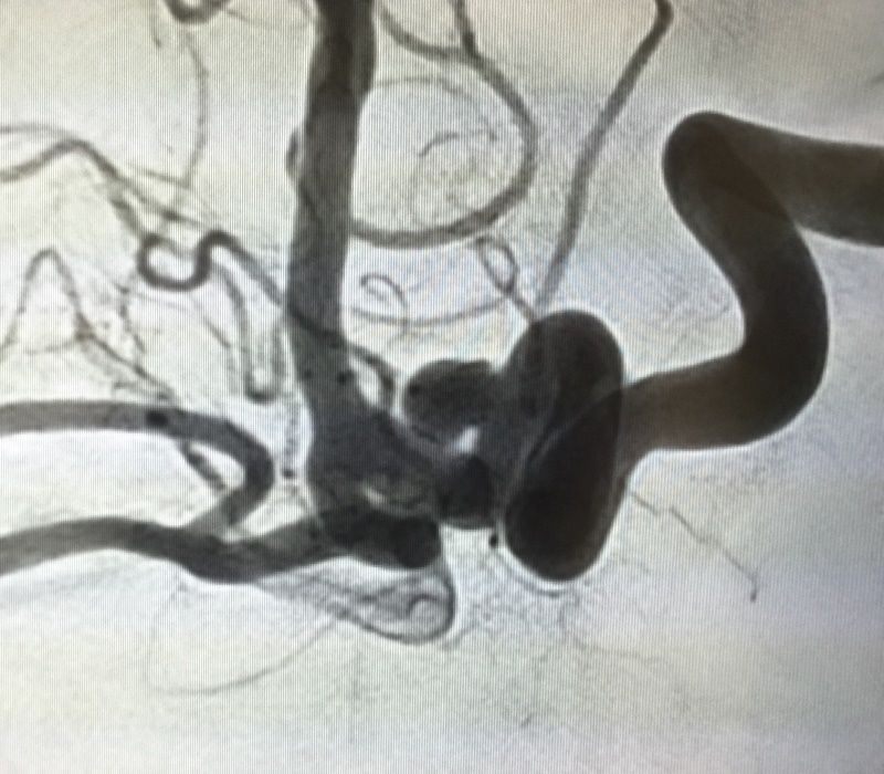 Intervención por cateterismo para el tratamiento de aneurisma