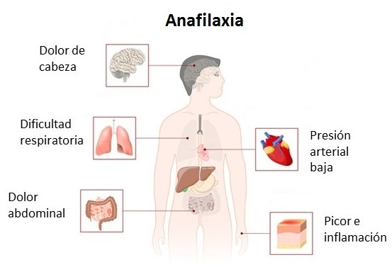 Síntomas de la anafilaxia