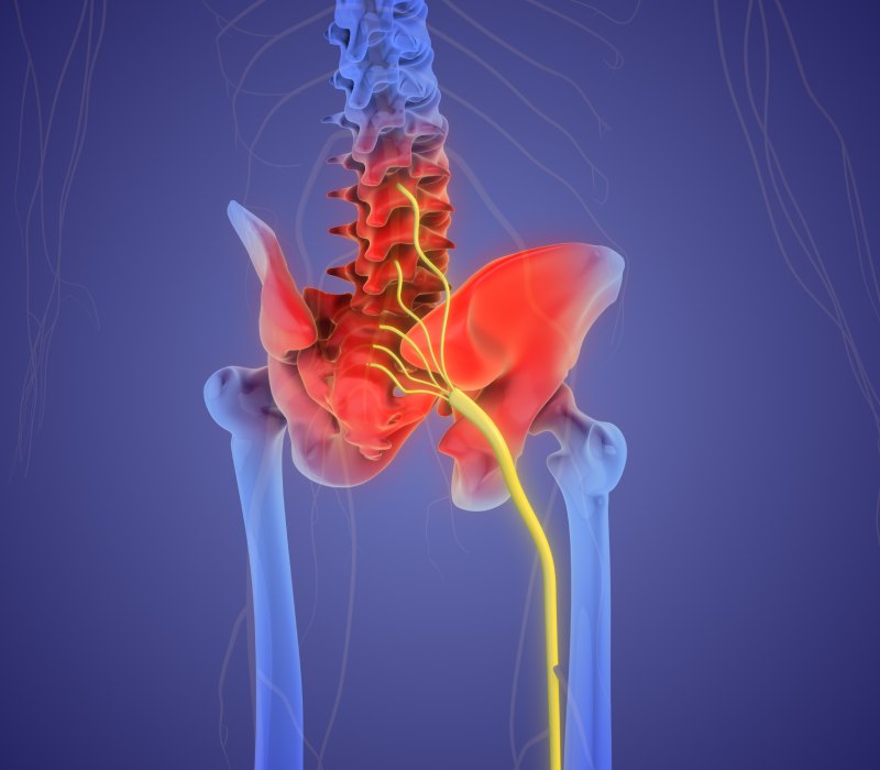 ¿Lumbalgia o ciática? Síntomas, diagnóstico y tratamientos