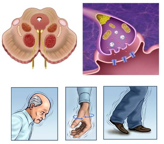Novedades en el tratamiento del Parkinson