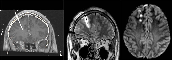 Las primeras imágenes muestran la implantación de un electrodo mostrando una lesión. En la última imagen se observan lesiones pequeñas generadas por el procedimiento.