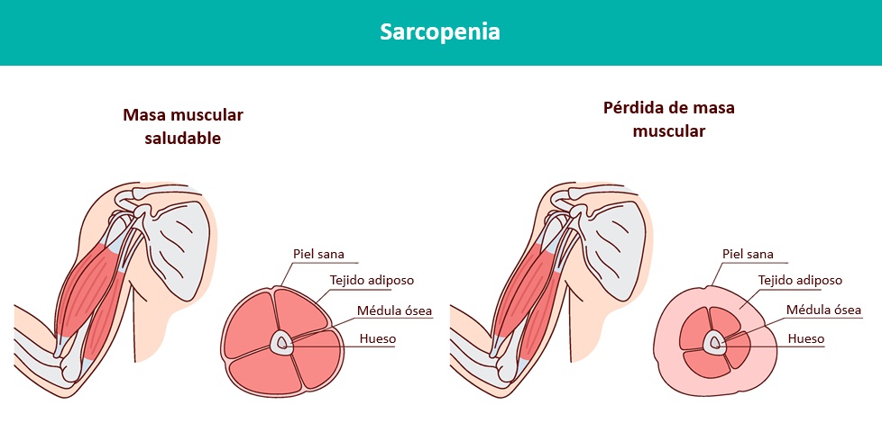 Infografía: Qué es la sarcopenia. Comparación de la masa muscular saludable y la pérdida de músculo a causa de la sarcopenia