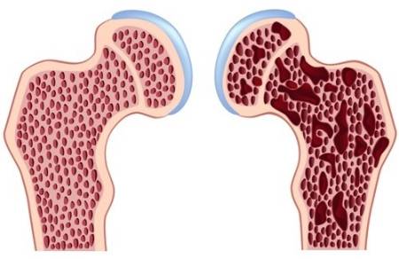 Diferencia entre un hueso sin y con osteoporosis