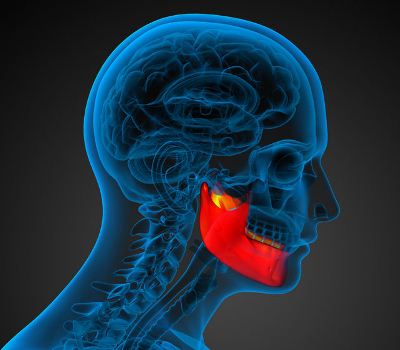 implante-mandibula