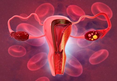 ¿Qué es el síndrome de ovarios poliquísticos?
