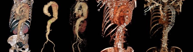 Sustitución completa de aorta paso a paso