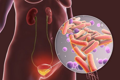 Ilustración sobre las infecciones urinarias