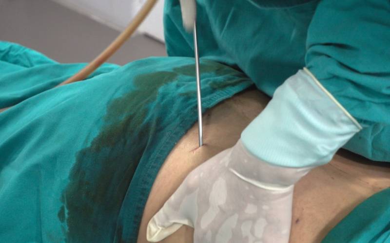 Body Jet, una liposucción con ventaja doble