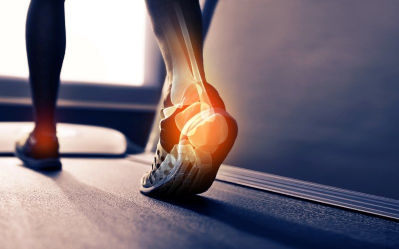 Fascitis plantar