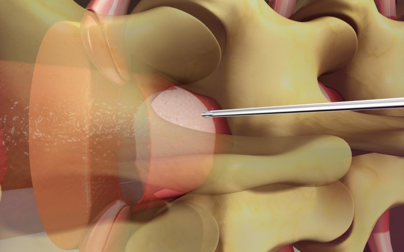 Analgesia epidural