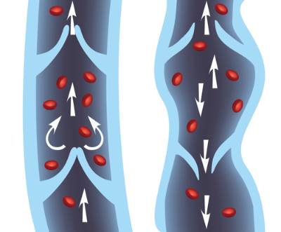 Comparación de una vena normal y una vena con varices