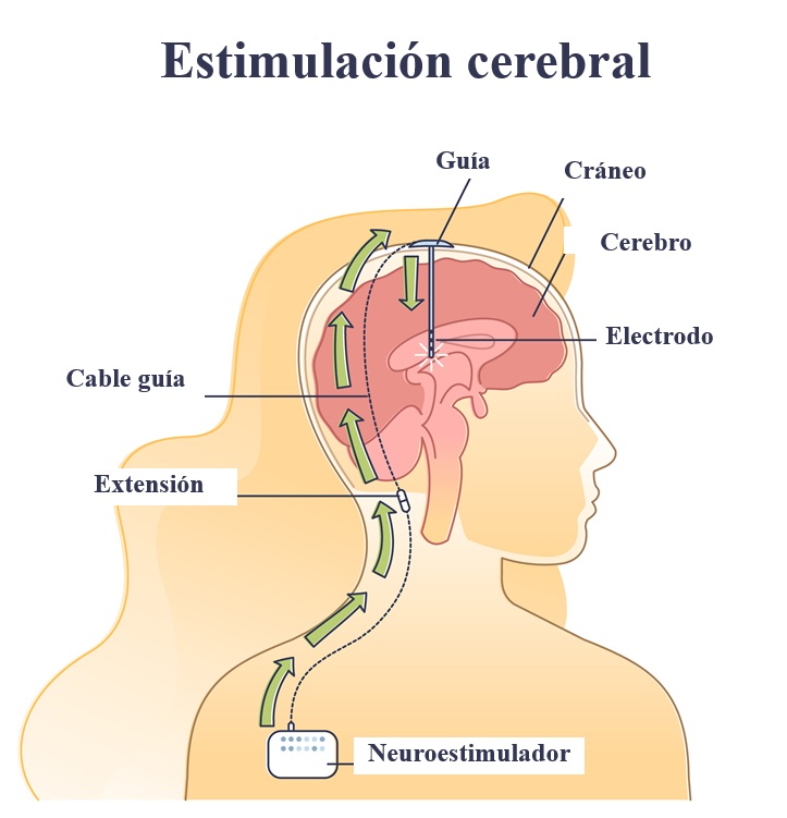 Infografía cómo se realiza la estimulación cerebral
