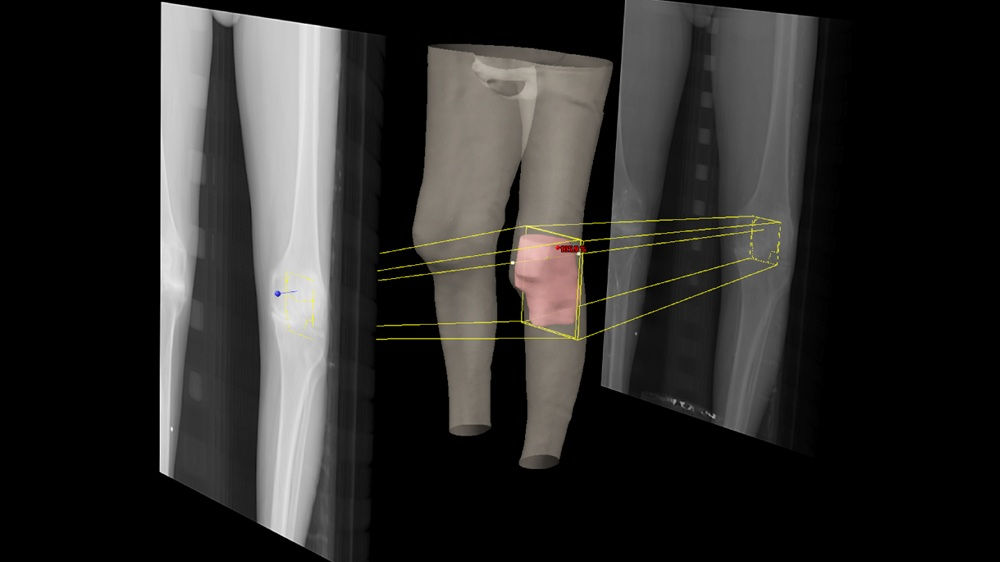 Imagen del tratamiento radioterápico de artrosis de rodilla