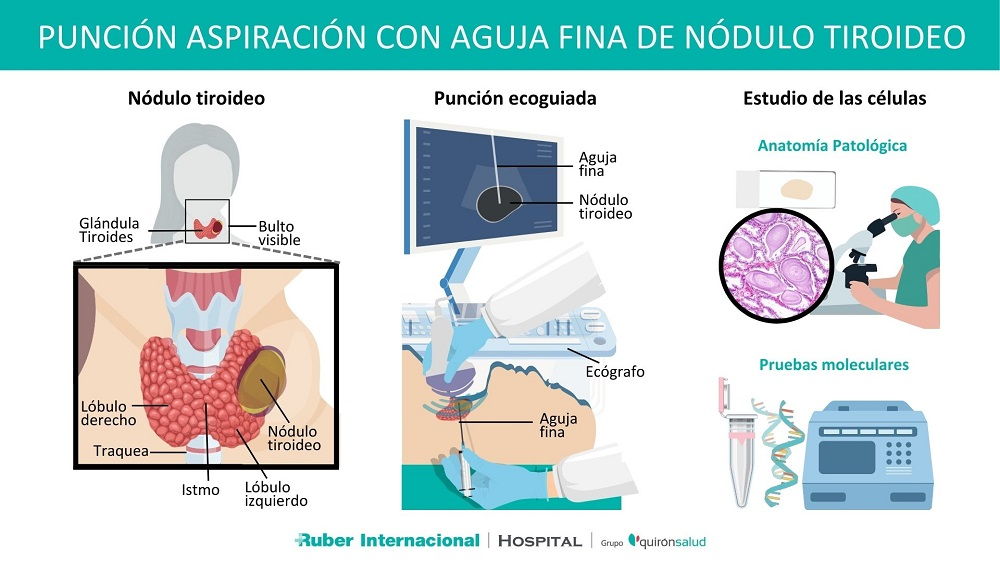 Técnica de diagnóstico de nódulos en la tiroides