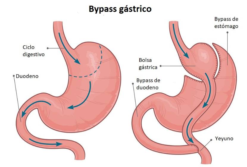 Abordaje en el Bypass gástrico o baipás