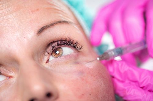Relleno de ácido hialurónico para eliminar las ojeras