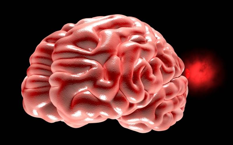 Tratamiento del aneurisma del cerebral con simulacion virtual
