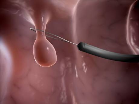 Pólipos del colon
