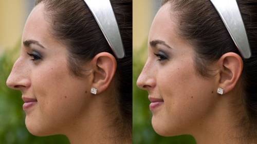 Rinoplastia, antes y después