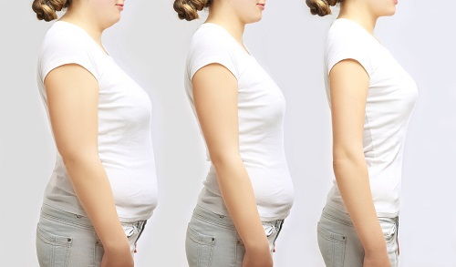 Liposucción, antes y después
