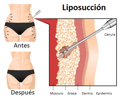 Se extrae la grasa localizada mediante una cánula