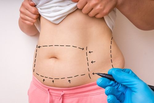 Lipoescultura para moldear la silueta