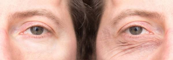 Blefaroplastia masculina