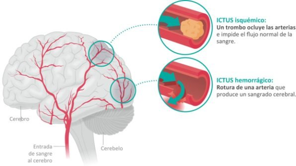 Explicación de tipos de ictus