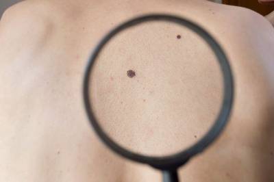 prevencion-melanoma