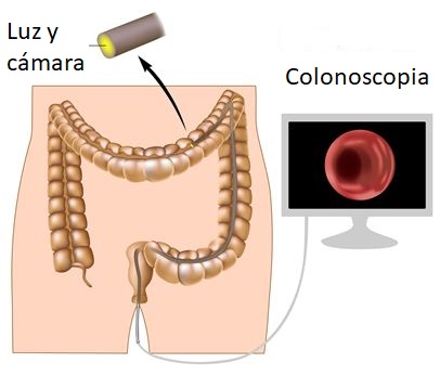 Diagnóstico precoz por screening en el cáncer colorrectal