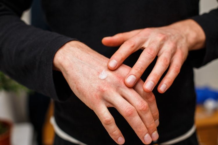Urticaria en las manos